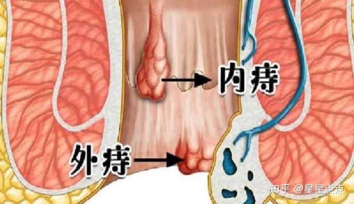 内痔疮最佳的自愈方法(内痔疮怎么治疗最好最快最有效)